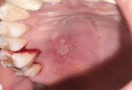 Image result for Oral herpes roof of mouth