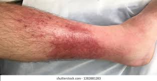 Image result for erysipel photos)