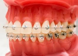 Check spelling or type a new query. Fastbraces Vs Invisalign Emmanuel Dental