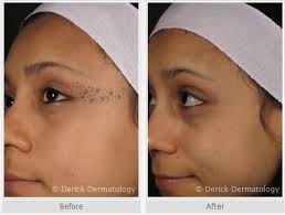 Tattoo removal has been performed with various tools since the start of tattooing. Laser Tattoo Removal Before And After Photo On The Face Winter Park Laser Uses A Q Swtiched Yag Laser To R Tattoo Removal Tattoo Removal Cream Laser Removal
