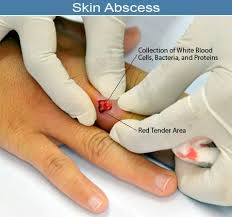 Image result for Skin Abscess
