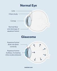Image result for Glaucoma