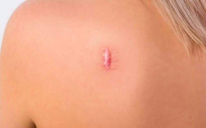Scar / Keloid Scar – Kovak Cosmetic Center Chicago Illinois