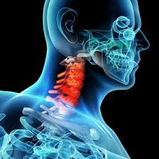 Mauvaise posture de la tête et du cou; Whiplash Cervical