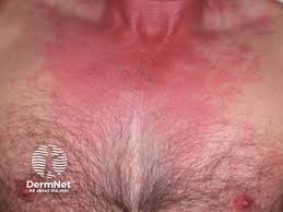 Image result for Scombroid Fish Poisoning