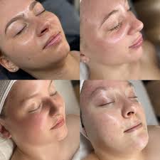 Natural skincare solutions for acne and aging