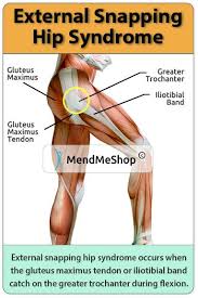 External Snapping Hip Syndrome Occurs When The It Band Or Gluteus Maximus Tendon Catch On The Greater Trochanter Snapping Hip Syndrome Hips Iliopsoas Bursitis
