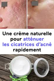 Une Creme Naturelle Pour Attenuer Les Cicatrices D Acne Rapidement Soap Bottle Hand Soap Bottle Hand Soap