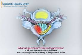 Maybe you would like to learn more about one of these? Ligamentum Flavum Hypertrophy Cause Treatment