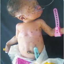 Itp is a disorder that can lead to easy or excessive bruising and bleeding. A C Neonatal Thrombocytopenic Purpura In Two Nigerian Download Scientific Diagram