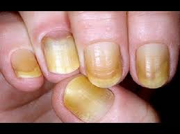 Kuku kuning ditandai dengan warna kuku yang berangsur berubah warna menjadi kuning. Kuku Jari Kaki Warna Kuning 06 Kuku