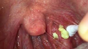 Tonsil stones, also known as tonsilloliths, are mineralizations of debris within the crevices of the tonsils. Meet The Bizarre Reddit Community Obsessed With Digging Out Tonsil Stones On Camera The Independent The Independent