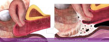 Endometriosis is a condition where tissue similar to the lining of the womb starts to grow in other places, such as the ovaries and fallopian tubes. Endometriosis Symptoms Painful Sex Dyspareunia Endofound