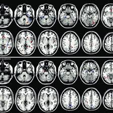 Asperger syndrome (also referred to as asperger disorder) is a term applied to a form of autism spectrum disorder (asd) characterized by persistent impairment in social interactions and by repetitive behavior patterns and restricted interests. Pdf Can Asperger Syndrome Be Distinguished From Autism An Anatomic Likelihood Meta Analysis Of Mri Studies