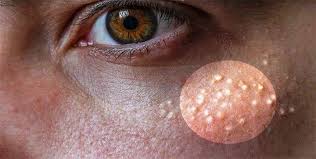 7 Remedies To Get Rid Of Milk Spots Naturally With Images Small Bumps On Forehead Pimples On Face Forehead Bumps