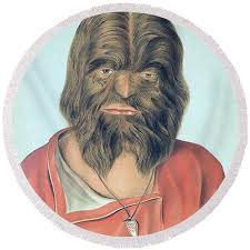 Image result for Hypertrichosis
