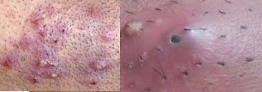 Although some ingrown hairs can cause. Pin On Ingrown Hair Prevention