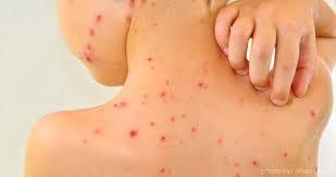 How to treat and prevent chicken pox. Chickenpox Cacar Air Aura Ummi