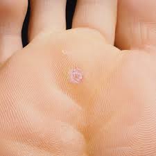 stop plantar warts in their tracks with