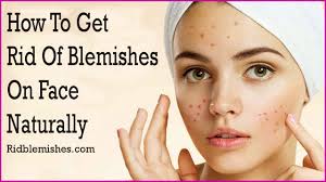 It has antibacterial and antifungal properties — the cool gel soothes inflamed skin, moisturizes it and reduces blemishes. How To Get Rid Of Blackheads Fast With Natural Acne Skin Care Products Get Rid Of Blemishes On Face