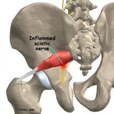 Osteopathy Massage And Acupuncture For Sciatica Osteopathy In Hatfield