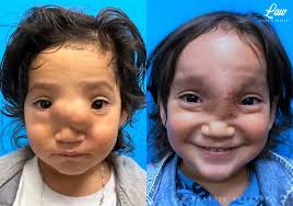 We just wrapped a tremendous breakthrough week of 25 advanced cleft and  craniofacial surgeries with our extraordinary surgical partners in  Nicaragua. Building