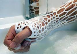 3d Printed Cast Prints Medical Design It Cast