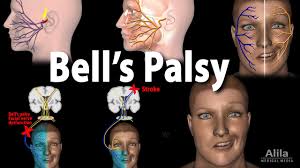 Or it might be a reaction that occurs after a viral infection. Bell S Palsy Pathophysiology Symptoms Diagnosis And Treatment Animation Youtube