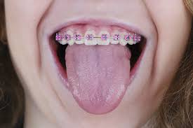 Jul 05, 2014 · type 2 rubber bands for braces are typically used for an overbite. Are Rubber Bands On Braces Important Ft Collins Co Orthodontist