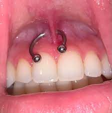 I Just Got My Smiley Pierced But It Looks Like She Pierced It Too Far Back Is This Bad Is This Gonna Affect The Healing My Gums I Am Not Sure