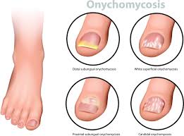 Toenail fungus is an infection that gets in through cracks in your nail or cuts in your skin. Help For Toenail Fungus Ingrown Nails Warts Corns Calluses Athlete S Foot Advanced Podiatry Services