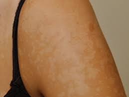 Tinea versicolor is a condition characterized by a skin eruption on the trunk and proximal extremities. Tinea Versicolor Pityriasis Versicolor Pictures Symptoms Causes Treatment Healthmd