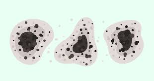 El hongo negro es una infección causada por un moho que se localiza en los ambientes húmedos como tierra o compost y que ataca las vías respiratorias (foto: Que Es El Hongo Negro Y Por Que Preocupa En Pandemia Salud Con Lupa