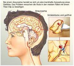 Aneurysma Ursachen Symptome Behandlung Medlexi De