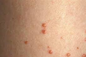 Both of these medications, used in clinical trials, where shown to clear up existing xanthomas in almost half of the patients who used them. Xanthoma Dermatology Advisor
