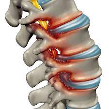 Spondylose Wirbelsaulen Verschleiss Alles Wichtige Dazu Liebscher Bracht