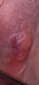 Visha skincare cheek 2 feet has witch hazel, tea tree oil, and thyme oil, which work to minimize ingrown hairs. RÄƒscoalÄƒ La ScarÄƒ LargÄƒ A Sufla Lymph Nodes Bikini Line Thuemaychieu Org