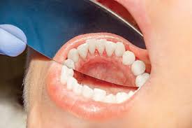 Image result for Canker sores symptoms roof of the mouth