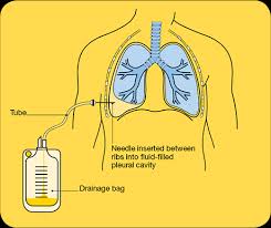 Image result for Thoracentesis