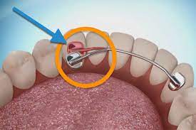The wire part wraps around all or part of your teeth. I Have A Broken Permanent Retainer Now What Premier Orthodontics
