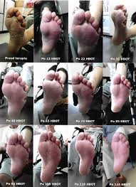 Stopa cukrzycowa powstaje w wyniku współistnienia trzech elementów. Stopa Cukrzycowa Leczenie Piety Cukrzycowej Zgierz Pabianice