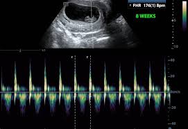 Baby S Heart Beat Does It Really Tell You The Baby S Gender Pregnancy Treasures