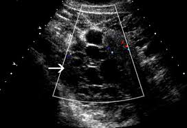 In cases of peritoneal mesothelioma, fluid can build up in the. Case 146 Benign Multicystic Mesothelioma Radiology