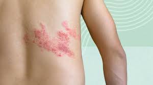 Image result for sweat rash on back