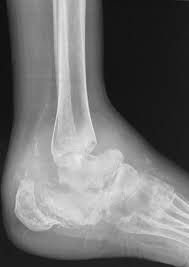 The bones become weak and can break and the joints in the foot or ankle can dislocate. Charcot Joint Radiology Case Radiopaedia Org