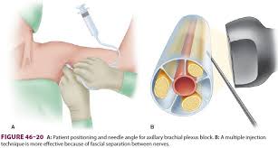 Image result for Axillary Nerve Block