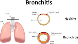 Image result for Acute Bronchitis