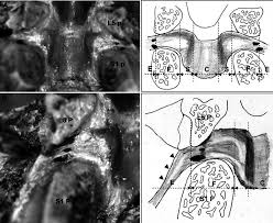 Ligamentum flavum — ligamentum fla·vum flā vəm n, pl ligamenta fla·va və any of a series of ligaments of yellow elastic tissue connecting the laminae of adjacent vertebrae from the axis to the sacrum … The Ligamentum Flavum At The L5 S1 Level Is Shown A In The Foraminal Download Scientific Diagram
