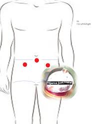 Haemorroids Front Points Cupping Therapy Hijama Cupping Massage
