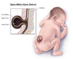 He came up with a method to determine the microbial cause of a disease, which are called koch's postulates. Neural Tube Defect Wikipedia